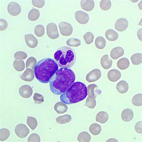 blasts in peripheral blood.